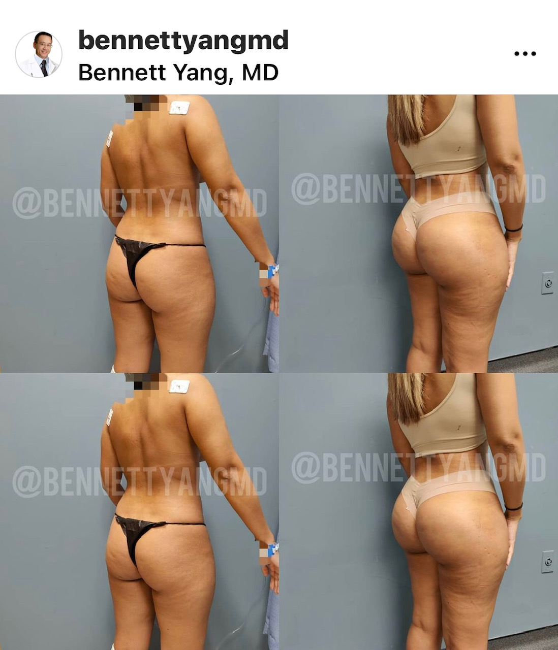 BBL Maryland Plastic Surgeon Bennett C. Yang