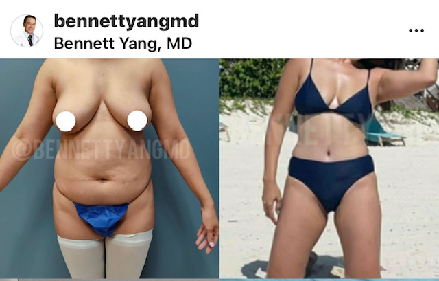 BBL Maryland Plastic Surgeon Bennett C. Yang