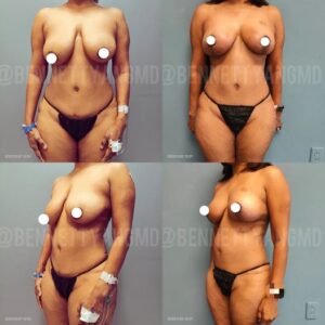 Expert Breast Lift Surgery Maryland - Correction