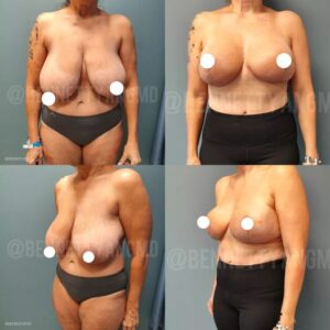 Expert Breast Lift Surgery Maryland - Correction