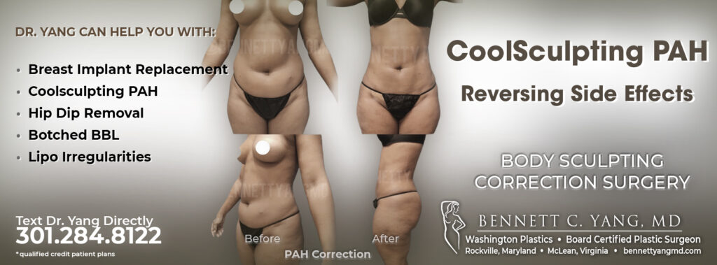 CoolSculpting Side Effect Correction - PAH