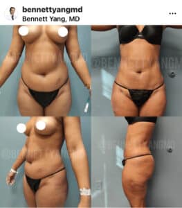 Correct CoolSculpting PAH Surgeon Near Me