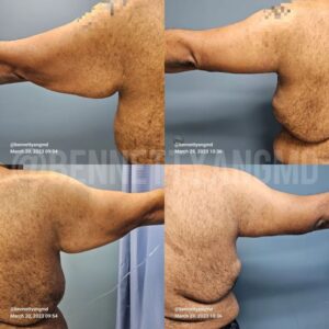 Arm Fat Removal Arm Skin Removal Arm Lift Liposuction Maryland