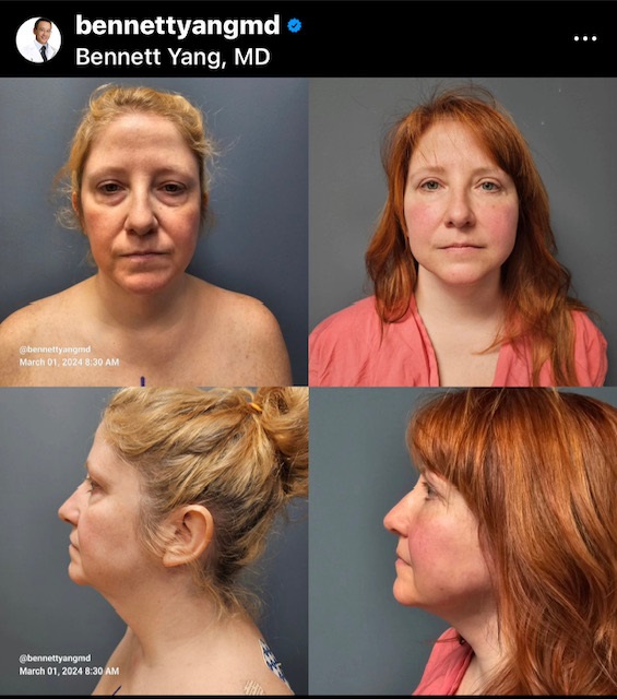 Maryland Face Surgeon Facelift Before and After